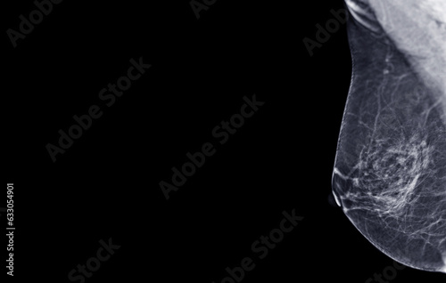 Fotografija X-ray Digital Mammogram of Right  side  MLO view .