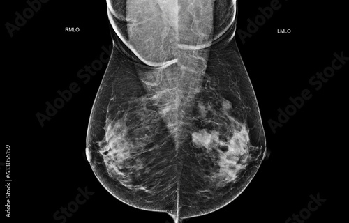 X-ray Digital Mammogram both side MLO view .