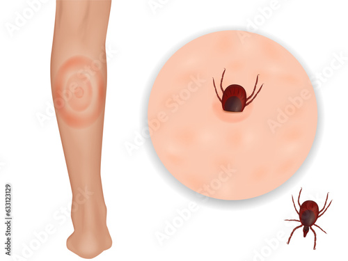 Lyme disease or Lyme borreliosis, is a disease caused by Borrelia bacteria. Erythema migrans