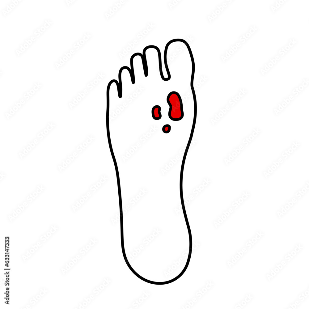 Diabetic Foot Ulcers Diabetic Foot Ulcers
