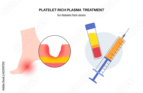 Diabetic Foot Ulcers