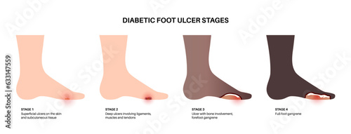 Diabetic Foot Ulcers