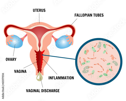 Medical infographic gynecology symptoms of bacterial vaginosis, vaginal discharge 