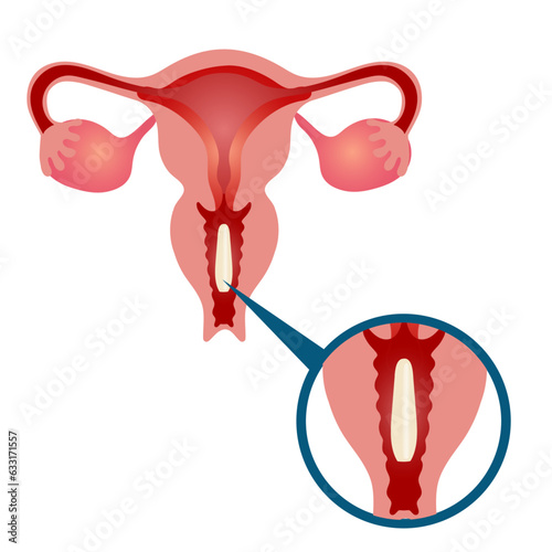 Medical infographic gynecology, bacterial vaginosis, vaginal discharge, treatment 