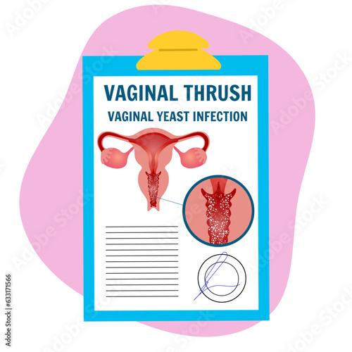 Bacteria vaginosis diagnosis medical illustration cartoon, gynecology 