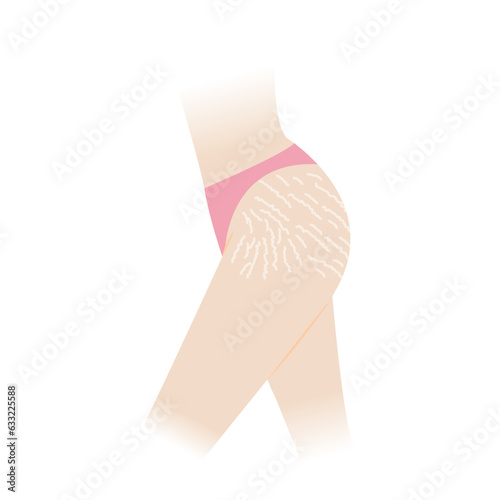 Stretch marks on hip and thigh vector illustration isolated on white background. The white stretch marks, striae albae appear on the hip and thigh side of woman body. Skin care and beauty concept.