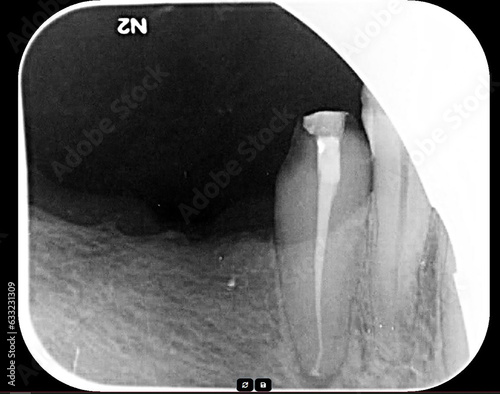 Dental root canal treatment imaging.  Endodontic therapy.