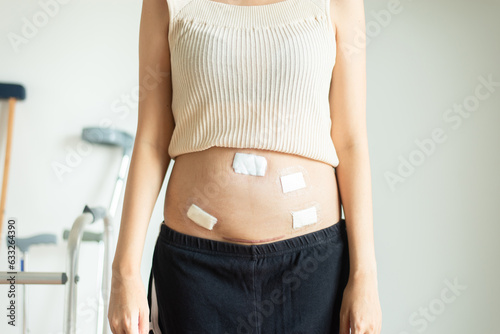 Patient woman using plaster on abdomen after laparoscopy,Surgery wound