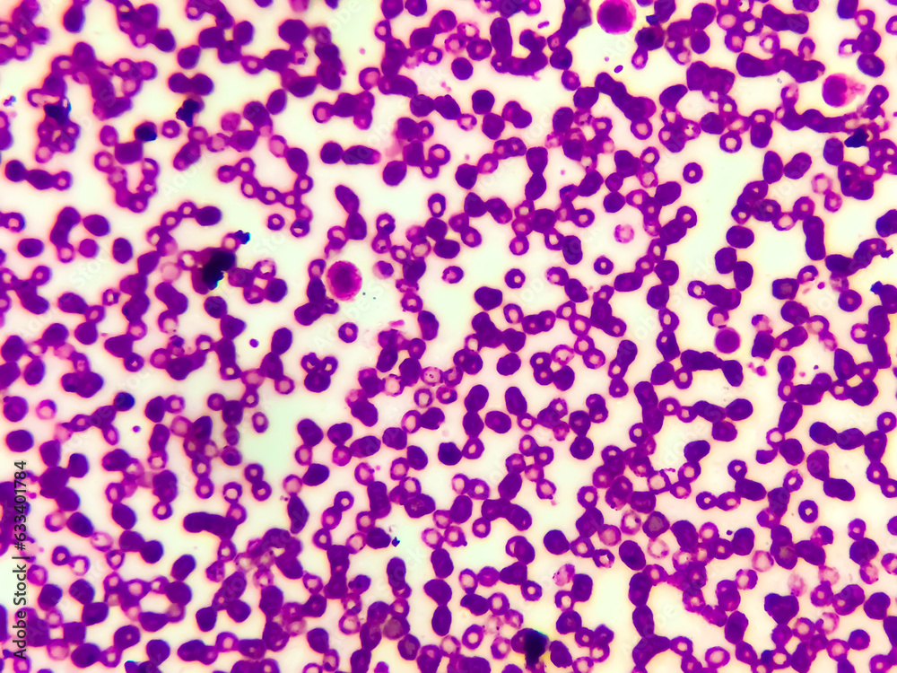 Microscopic image of macrocytic anaemia with thrombocytopenia, folic