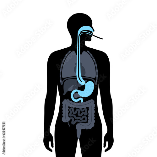 Esophageal achalasia disease