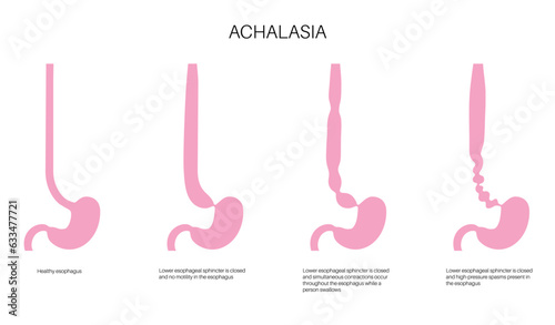 Esophageal achalasia disease