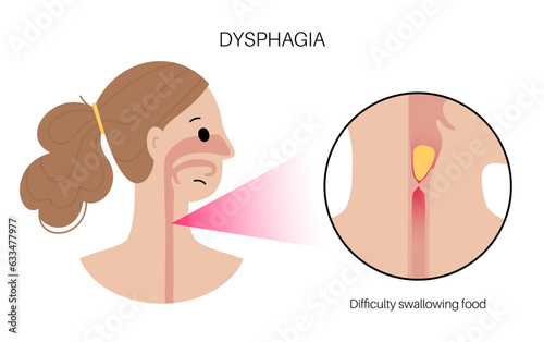 Dysphagia medical poster
