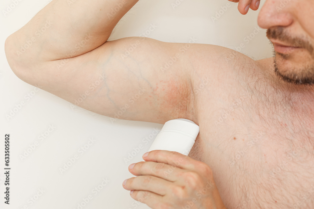 Young man with irritation, inflammation on sensitive underarm skin