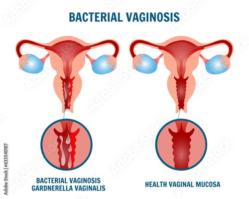 Gynecology disease, bacterial vaginosis, medical infographic 