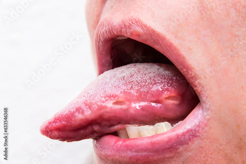 stained tongue due to stomach problems, canker sores, medicine photo