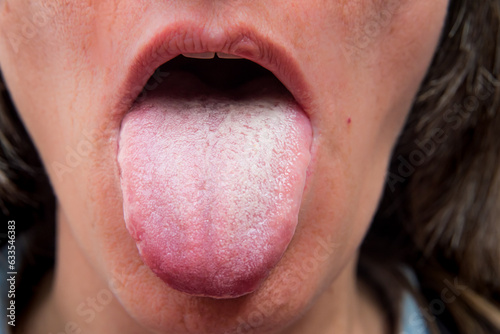stained tongue due to stomach problems, natural medicines photo