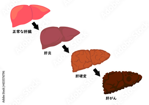 肝臓の病気の進行