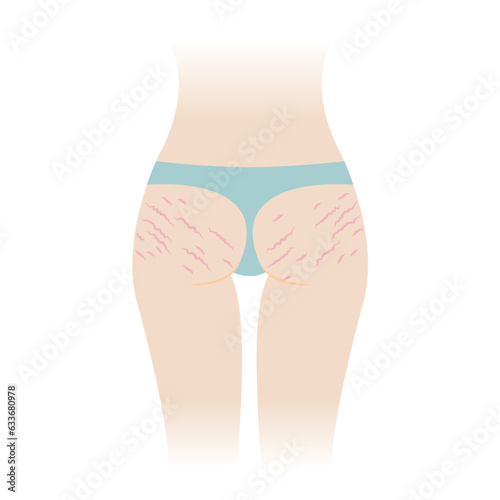 Red stretch marks on buttocks vector illustration isolated on white background. The striae rubrae appear on the bottom, hip, ass back of woman body. Skin care and beauty concept. photo