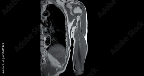 MRI Left humerus bone Coronal  T2W  for diagnosis bone tumor.  photo