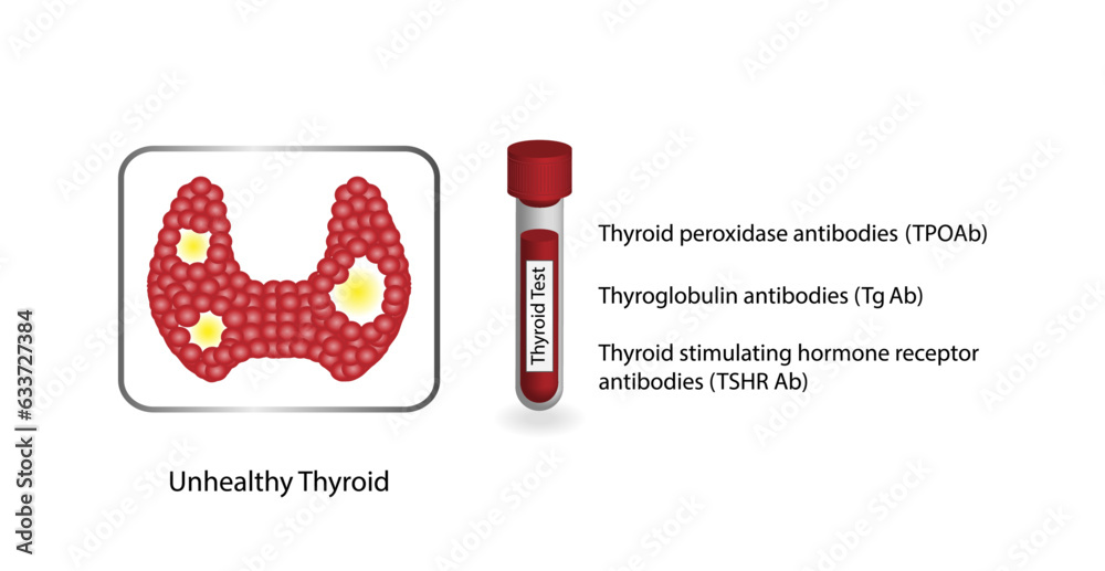 Thyroid gland, Thyroiditis. Thyroglobulin, Thyroid peroxidase and Thyroid stimulating hormone