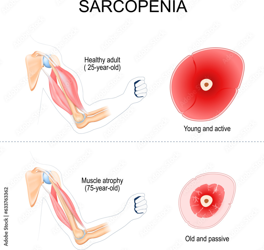 Fotografie sarcopenia. muscle atrophy