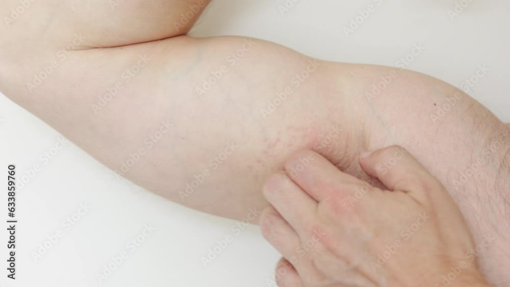 Armpit rash, Acne or red spots. Unrecognisable man scratches irritation by hand on sensitive skin after using a razor, trimmer, deodorant or antiperspirant. Allergy, irritation or atopic dermatitis. Armpit rash, Acne or red spots. Unrecognisable man scratches irritation by hand on sensitive skin after using a razor, trimmer, deodorant or antiperspirant. Allergy, irritation or atopic dermatitis.
