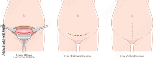 Types of C-section incisions　帝王切開