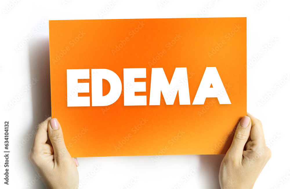 Edema is swelling caused by excess fluid trapped in your body's tissues