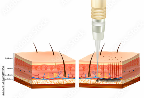 The Tattooing Process. Tattoo Pigment under skin of Epidermis, Dermis and Hypodermis
