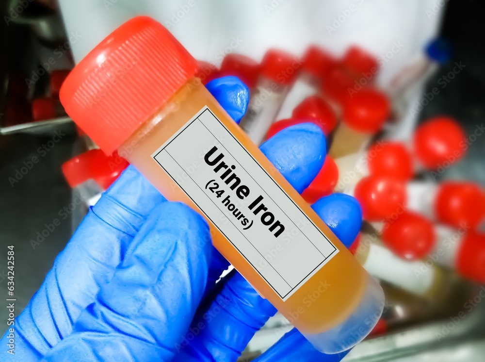 24 hours urinary Iron test, to diagnose of iron over load conditions