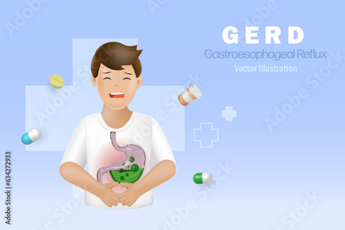 GERD gastroesophageal reflux acid on patient stomach. Digestive disorder causes patient heartburn pain or acid reflux indigestion. Medical and healthcare. 3D vector.