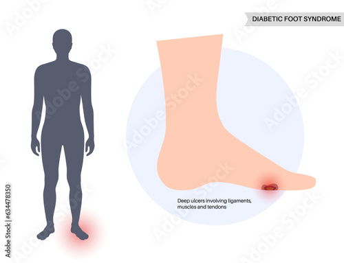 Diabetic Foot Ulcers