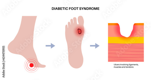 Diabetic Foot Ulcers photo