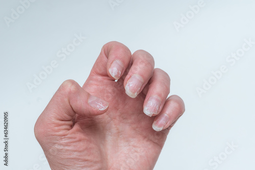 Bitten and broken nails without manicure with overgrown cuticle of nail and a damaged nail plate after applying gel polish