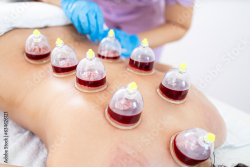 Hijama master performs a vacuum blood suction procedure on patient skin.