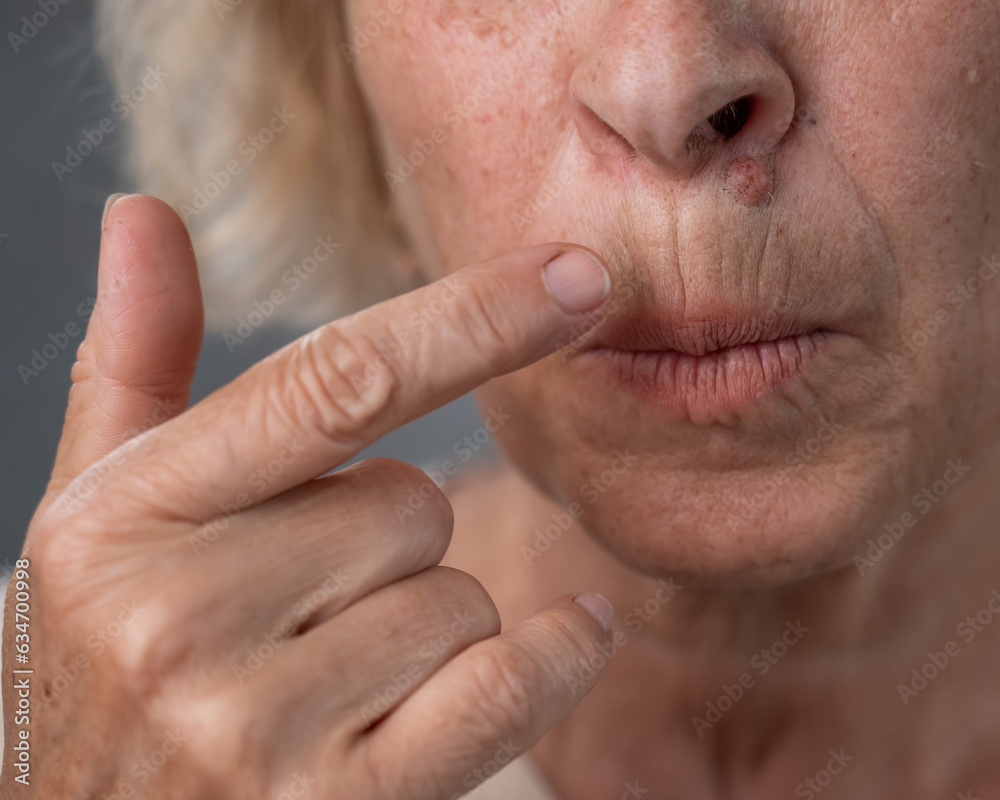 Unhappy elderly woman pointing at wrinkles around her lips. Unhappy elderly woman pointing at wrinkles around her lips.