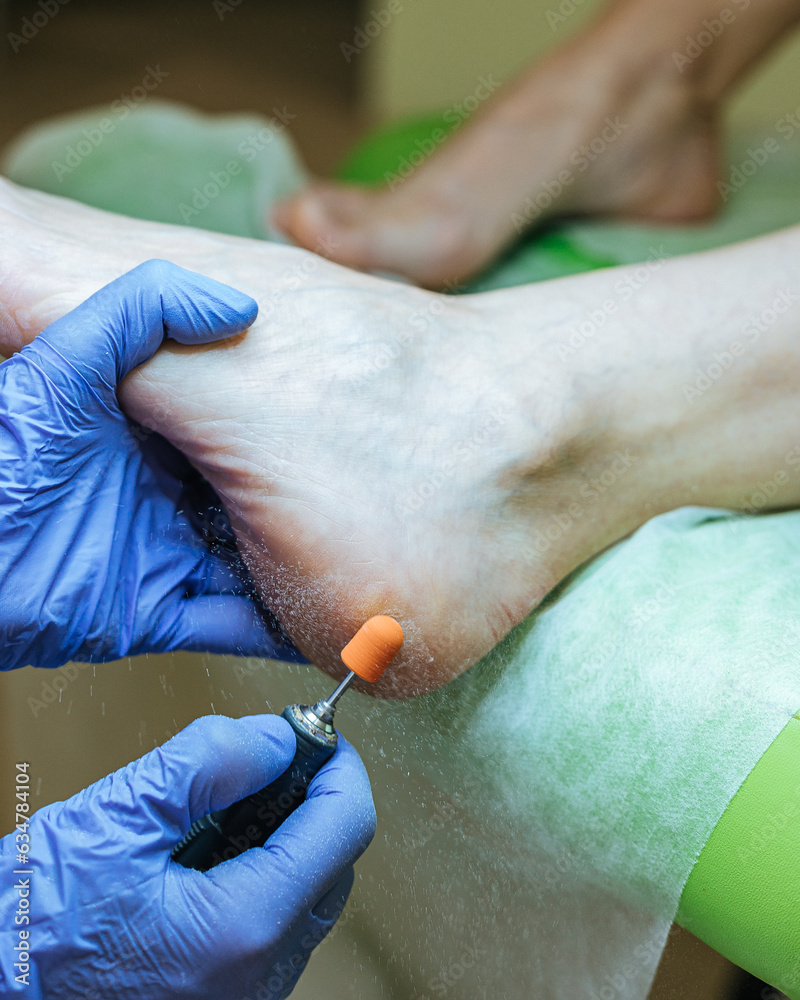 A close-up of the process of making a pedicure by a master. Foot care in medical centers. Professional medical pedicure procedure while doctor using nail instrument. Treatment of the skin of the foot 
