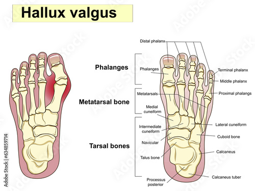 Hallux valgus text. Anatomy. Human foot bones. Signatures, also for clinics photo