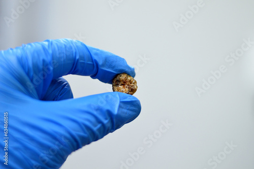 A gallstone removed surgically after laparoscopic cholecystectomy, Gallstones are hardened deposits of digestive fluid that can form in gallbladder with two types, cholesterol and pigment stones photo