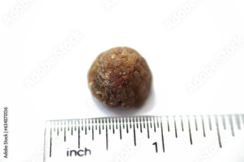 Size of gallstone removed surgically after laparoscopic cholecystectomy, Gallstones are hardened deposits of digestive fluid that can form in gallbladder with two types, cholesterol and pigment stones photo