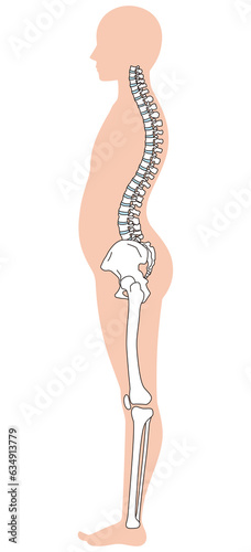 反り腰の姿勢　骨盤の傾き photo