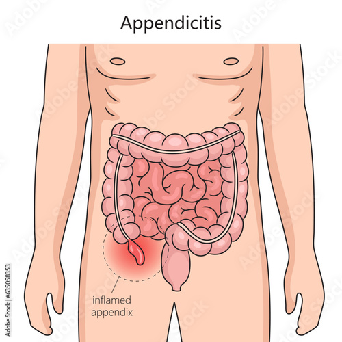 Appendicitis inflammation of the appendix diagram schematic vector illustration. Medical science educational illustration photo