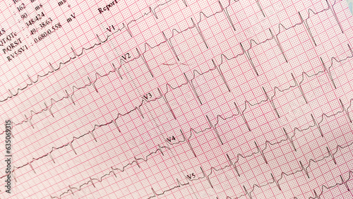 Electrocardiogram show normal heart beat line (Sinus rhythm). Normal 12-lead sinus rhythm ECG.  ECG. EKG. Vital sign. Medical healthcare symbol.