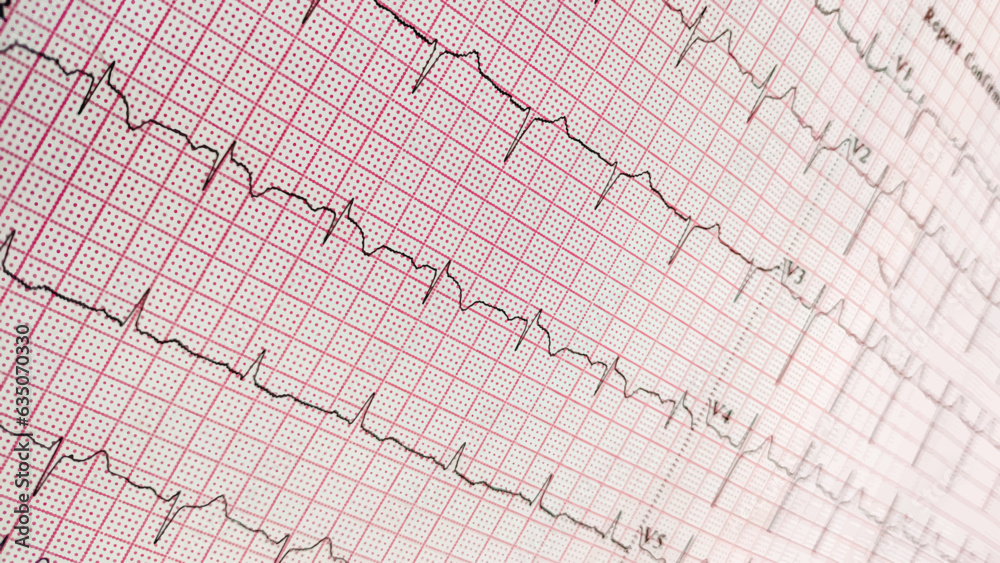 ECG. EKG, Electrocardiogram show Sinus bradycardia pattern. Cardiac fibrillation. Normal 12-lead sinus rhythm ECG. Vital sign. Medical healthcare symbol. ECG. EKG, Electrocardiogram show Sinus bradycardia pattern. Cardiac fibrillation. Normal 12-lead sinus rhythm ECG. Vital sign. Medical healthcare symbol.