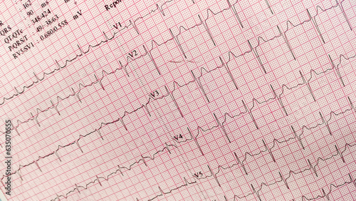 ekg pulse rate red grid paper that shows sinus rhythm abnormality of right ventricular hypertrophy. Cardiac fibrillation. Vital sign. Medical healthcare symbol.
