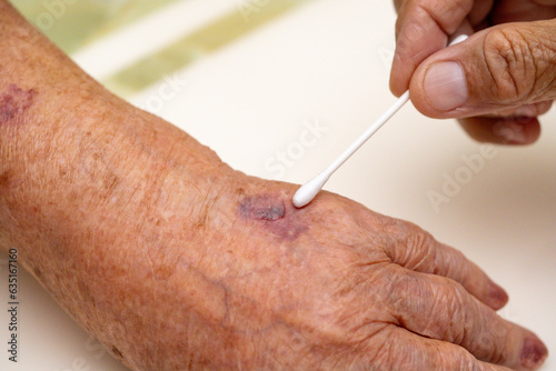 Close up old woman hand, upper limb or arm to the wounded waiting for nurse treatment on wound dressing a bloody and brine of patient.