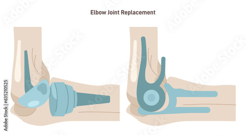 Joint implantation. Injured or distracted human joint replaced with artificial