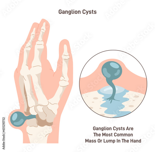 Ganglion cyst. Fluid-filled lump under the skin of a wrist or hand. Synovial