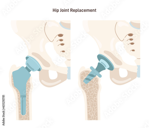Joint implantation. Injured or distracted human joint replaced with artificial