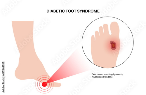 Diabetic Foot Ulcers photo